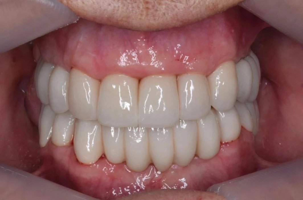 Estado gingival e implante previo a prótesis definitiva
